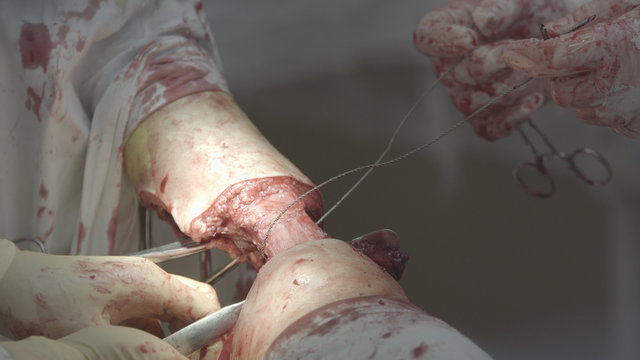 Amputation With Gigli Saw