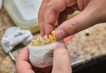 Artificial teeth, prosthetics, hands while working on the denture, false teeth, a table with dental tools