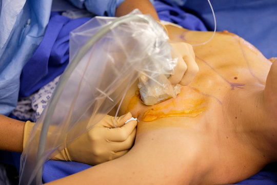 Anesth&eacute;sie loco r&eacute;gionale