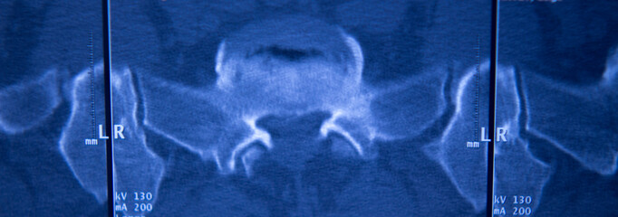 Medical hips spine pelvis MRI scan
