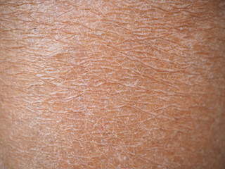Dry skin (ichthyosis) texture detail on leg women using for skincare and moisturizer lotion, cream...