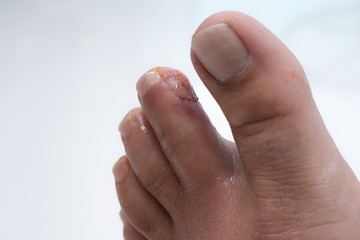 Finger on the leg. Purulent finger. Wound close up. purulent wound