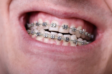 Metal orthodontic braces on crooked ugly teeth close-up. Ugly smile. Dental concept, medicinal...