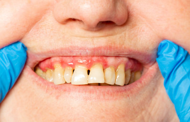 teeth with periodontitis close up