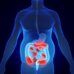 3D illustration showing Morbus Crohn - inflammatory bowel disease