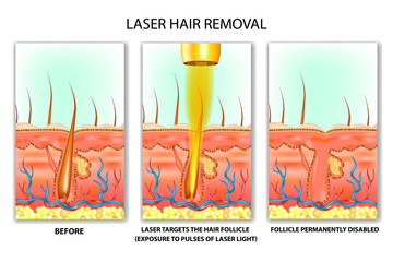 Laser hair removal. Exposure to pulses of laser light