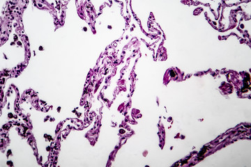 Histopathology of lung emphysema, light micrograph, photo under microscope showing enlargement of...