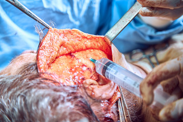 Facial plastic surgery operation. Face lift surgery. Surgeon separated the skin from the patient's...