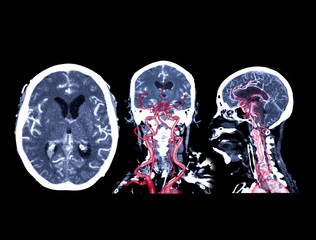 Collection of CT angiography of the brain or CTA brain comparison Axial , Coronal and Sagittal view...