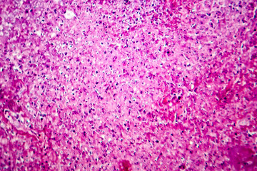 Caseation of human tuberculosis granuloma, light micrograph, photo under microscope. Caseous necrosis, necrotizing granulomatous inflammation