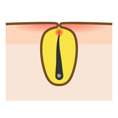 ムダ毛処理・脱毛トラブル毛嚢炎(毛包炎)のイラスト