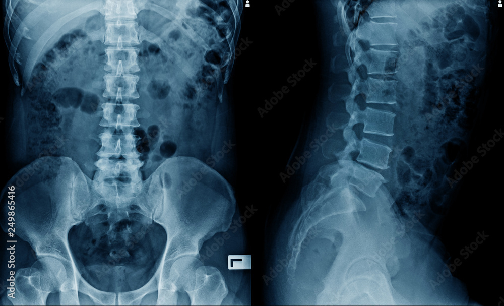 Poster x-ray image of spine