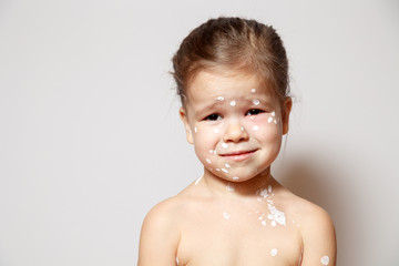 Closeup face cute little girl with varicella virus or chickenpox bubble rash, conjunctivitis, sore eyes, red spots covered zinc lotion calamine. Concept of infectious quarantine in kindergarten