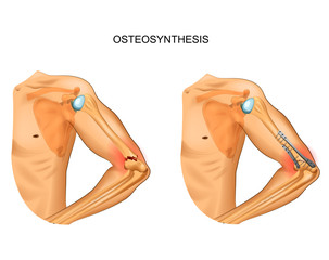 osteosynthesis in fracture of distal humerus - obrazy, fototapety, plakaty