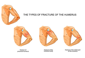 humerus fracture, trauma, surgery - obrazy, fototapety, plakaty