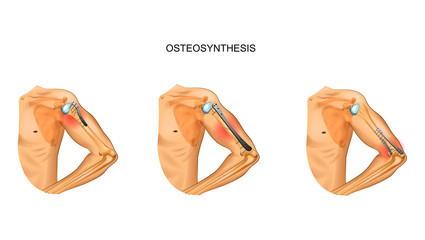 osteosynthesis of the humerus