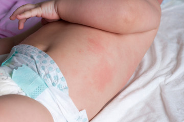 Irritation, allergies, diathesis on the body of an infant. Selective focus.