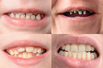 A set of four photographs of people with curves and rotten teeth