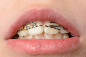 Close-up mouth of crooked teeth with braces Toothbrush in the mouth of the adolescent