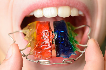 Close-up mouth of crooked teeth with braces Toothbrush in the mouth of the adolescent