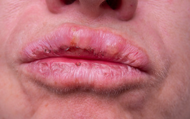 Fototapeta premium herpes on the female lips macro. Colds. Close-up.
