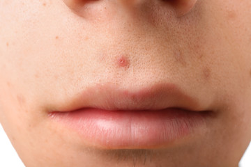 Teenager with acne problem, closeup