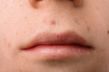 Teenager with acne problem, closeup