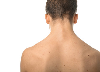 Naklejka premium Teenager with acne problem on white background