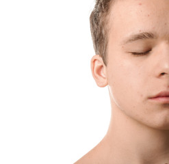 Fototapeta premium Teenager with acne problem on white background