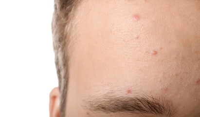 Fototapeta premium Teenager with acne problem, closeup