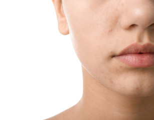 Girl with acne problem on white background, closeup