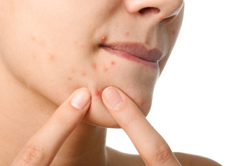 Girl with acne problem on white background, closeup