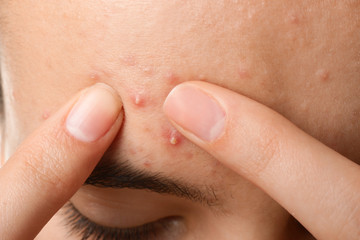 Fototapeta premium Girl with acne problem, closeup