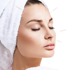 Woman undergoing acupuncture treatment.