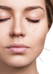 Woman undergoing acupuncture treatment. - 250032889