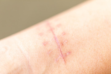 A scar is an area of fibrous tissue that replaces normal skin after an injury on skin. 