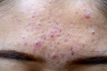 Backgrounds of lesions skin caused  by acne on the face in the clinic.
