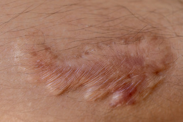 A scar is an area of fibrous tissue that replaces normal skin after an injury on skin. 