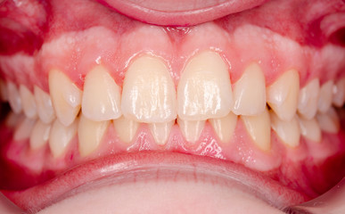 closeup of healthy frontal teeth