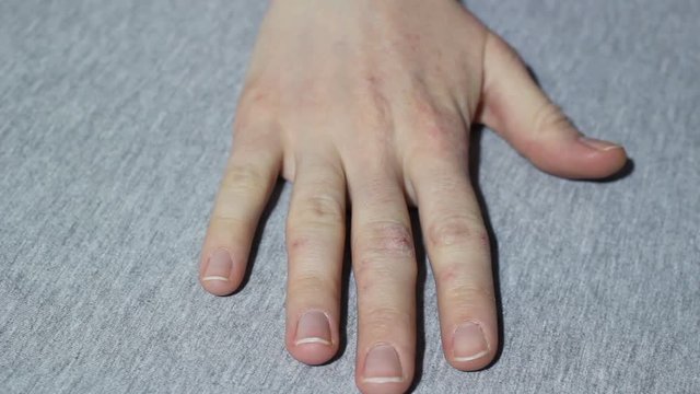 Hand girls with eczema and psoriasis. Close up