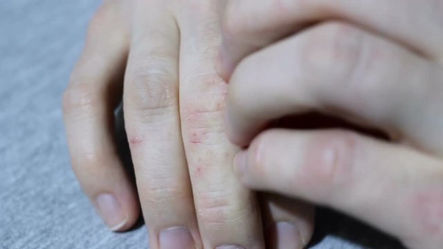 Girl's hand with eczema and psoriasis strong itching