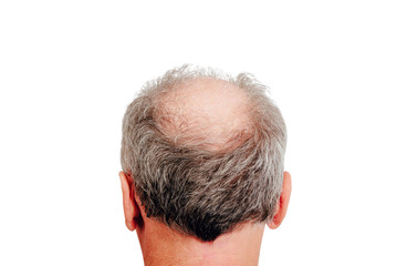 Rear view of a male head without hair. Hair loss concept, bird's nest on the head. Problems with hair regrowth, shampoo for facial hair growth.