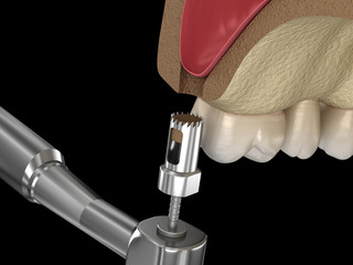 Sinus Lift Surgery - Creating an access to the Sinus. 3D illustration