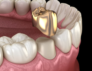 Golden crown premolar tooth assembly process. Medically accurate 3D illustration of human teeth treatment