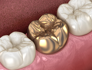 Golden crown molar tooth assembly process. Medically accurate 3D illustration of human teeth treatment