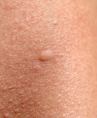 Fototapeta premium Bee sting on human skin.