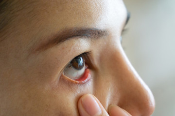 woman red eye dry close up, fatigue, conjunctivitis problems with blood vessels..Medicine healthcare blood capillary allergy eye pain.