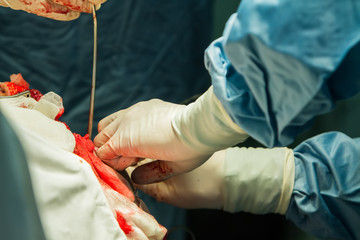 Close-up of the hands of surgeons holding pliers and suction, during trepanation of the skull.
