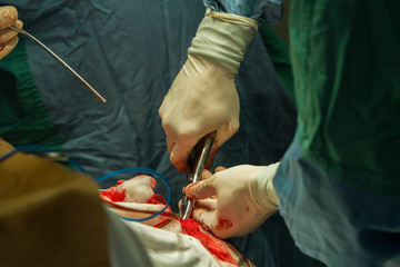 Close-up of a surgeon's hand with tongs breaking a skull bone.