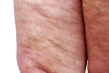 Naklejka premium The varicose veins